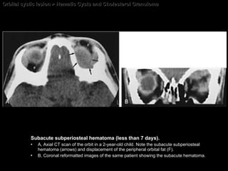 Orbital cystic lesion > Hematic Cysts and Cholesterol Granuloma Subacute subperiosteal hematoma (less than 7 days).  A, Axial CT scan of the orbit in a 2-year-old child. Note the subacute subperiosteal hematoma (arrows) and displacement of the peripheral orbital fat (F).  B, Coronal reformatted images of the same patient showing the subacute hematoma. 
