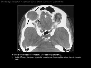 Orbital cystic lesion > Hematic Cysts and Cholesterol Granuloma Chronic subperiosteal hematoma (cholesterol granuloma). Axial CT scan shows an expansile mass (arrows) compatible with a chronic hematic cyst. 