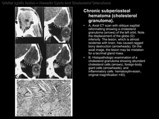 Orbital cystic lesion > Hematic Cysts and Cholesterol Granuloma Chronic subperiosteal hematoma (cholesterol granuloma). A, Axial CT scan with oblique sagittal reformatting showing a cholesterol granuloma (arrows) of the left orbit. Note the displacement of the globe (G) inferiorly. The lesion, which is almost isodense with brain, has caused ragged bony destruction (arrowheads). On the axial image, the lesion may be mistaken for a lacrimal gland mass.  B, Histopathologic examination of a cholesterol granuloma showing abundant cholesterol cells (arrows), foreign-body giant cells (arrowheads), and inflammatory cells  hematoxylin-eosin, original magnification ×40). 