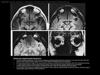 Orbital cystic lesion > Hematic Cysts and Cholesterol Granuloma Subacute subperiosteal hematoma.  A, Axial contrast-enhanced T1WI  shows a subacute subperiosteal hematoma (arrows) in an 8-year-old child. Note the high to mixed signal intensity pattern on the T1WI. Note the fluid-fluid level (arrowheads).  B, Axial proton-density image of the same patient showing a fluid-fluid level (arrowheads) within the hematoma (arrows). C, Axial T2WI showing a mixed signal intensity pattern with hypointensity images related to the intracellular methemoglobin portion of the subacute hematoma (arrows). Note the fluid-fluid level (arrowheads).  D, Coronal T1WI reveals an excellent demonstration of the subacute subperiosteal hematoma (arrows). Note the high to intermediate signal intensity of the hematoma. 
