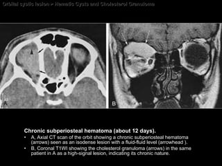 Orbital cystic lesion > Hematic Cysts and Cholesterol Granuloma Chronic subperiosteal hematoma (about 12 days). A, Axial CT scan of the orbit showing a chronic subperiosteal hematoma (arrows) seen as an isodense lesion with a fluid-fluid level (arrowhead ).  B, Coronal T1WI showing the cholesterol granuloma (arrows) in the same patient in A as a high-signal lesion, indicating its chronic nature. 
