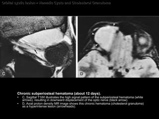 Orbital cystic lesion > Hematic Cysts and Cholesterol Granuloma Chronic subperiosteal hematoma (about 12 days). C, Sagittal T1WI illustrates the high signal pattern of the subperiosteal hematoma (white arrows), resulting in downward displacement of the optic nerve (black arrow).  D, Axial proton density MR image shows this chronic hematoma (cholesterol granuloma) as a hyperintense lesion (arrowheads). 