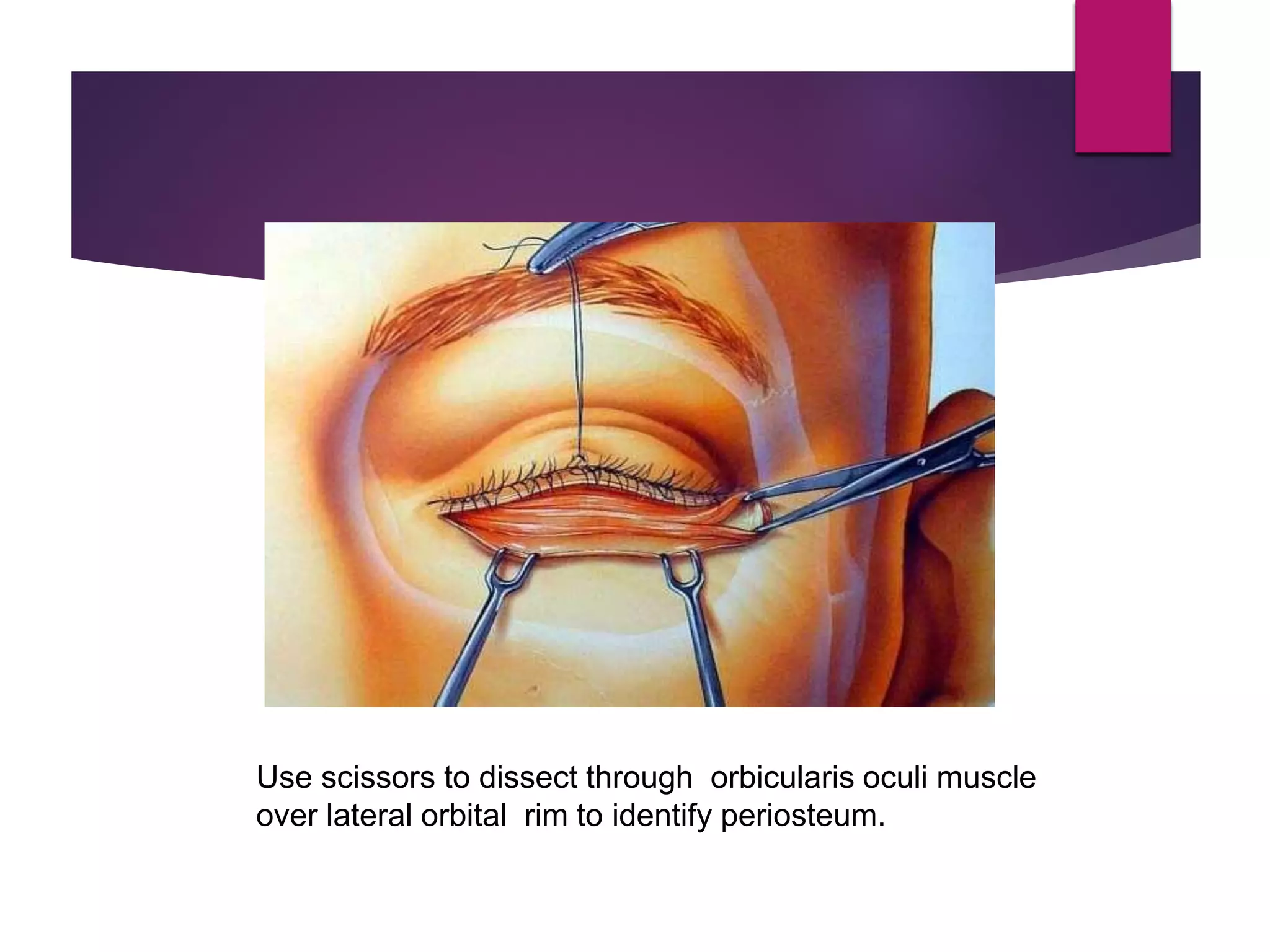 Orbital Fracture & Management | PDF