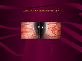 CAROTICO-CAVERNOUS FISTULA 