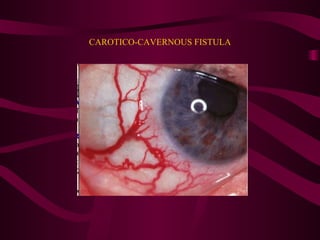 CAROTICO-CAVERNOUS FISTULA 