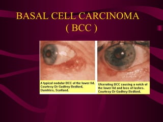BASAL CELL CARCINOMA  ( BCC ) 