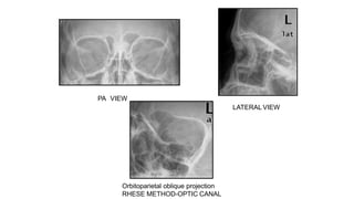 Reverse Rhese Method Orbital Apex conditions ophthalmology.pptx