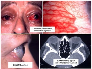 EOM thickening typical
without tendon involvement
Exophthalmos
Lid edema, chemosis and
conjunctival injection
 