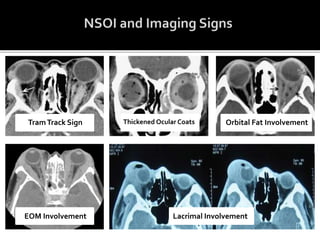 TramTrack Sign Thickened Ocular Coats Orbital Fat Involvement
EOM Involvement Lacrimal Involvement
 
