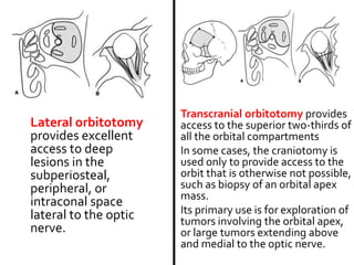 Lateral orbitotomy
provides excellent
access to deep
lesions in the
subperiosteal,
peripheral, or
intraconal space
lateral to the optic
nerve.
Transcranial orbitotomy provides
access to the superior two-thirds of
all the orbital compartments
In some cases, the craniotomy is
used only to provide access to the
orbit that is otherwise not possible,
such as biopsy of an orbital apex
mass.
Its primary use is for exploration of
tumors involving the orbital apex,
or large tumors extending above
and medial to the optic nerve.
 