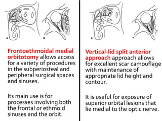 Frontoethmoidal medial
orbitotomy allows access
for a variety of procedures
in the subperiosteal and
peripheral surgical spaces
and sinuses.
Its main use is for
processes involving both
the frontal or ethmoid
sinuses and the orbit.
Vertical-lid split anterior
approach approach allows
for excellent scar camouflage
with maintenance of
appropriate lid height and
contour.
It is useful for exposure of
superior orbital lesions that
lie medial to the optic nerve.
 