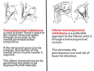 Transconjunctival orbitotomy
is used to enterTenon's space or
the medial intraconal space
through an incision in the
medial perilimbal bulbar
conjunctiva.
If the intraconal space is to be
entered, disinsertion of the
medial rectus muscle usually is
required.
This allows improved access by
permitting the globe to be
displaced further laterally.
Inferior transonjunctival
orbitotomy is a preferable
approach to the inferior orbit is
through a transconjunctival
incision.
This eliminates the
percutaneous scar and risk of
lower lid retraction.
 