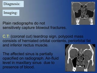 Tear Sign Orbital Floor Fracture Teardrop Sign
