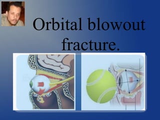 Orbital blowout
fracture.
 