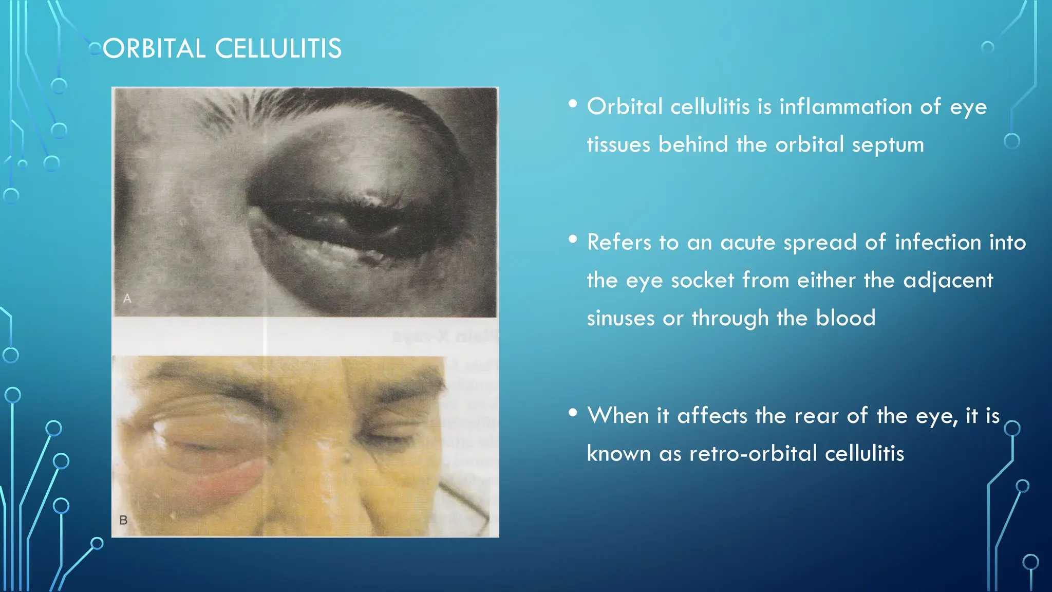orbitalcellulitis_with explanation_eye problem.pptx
