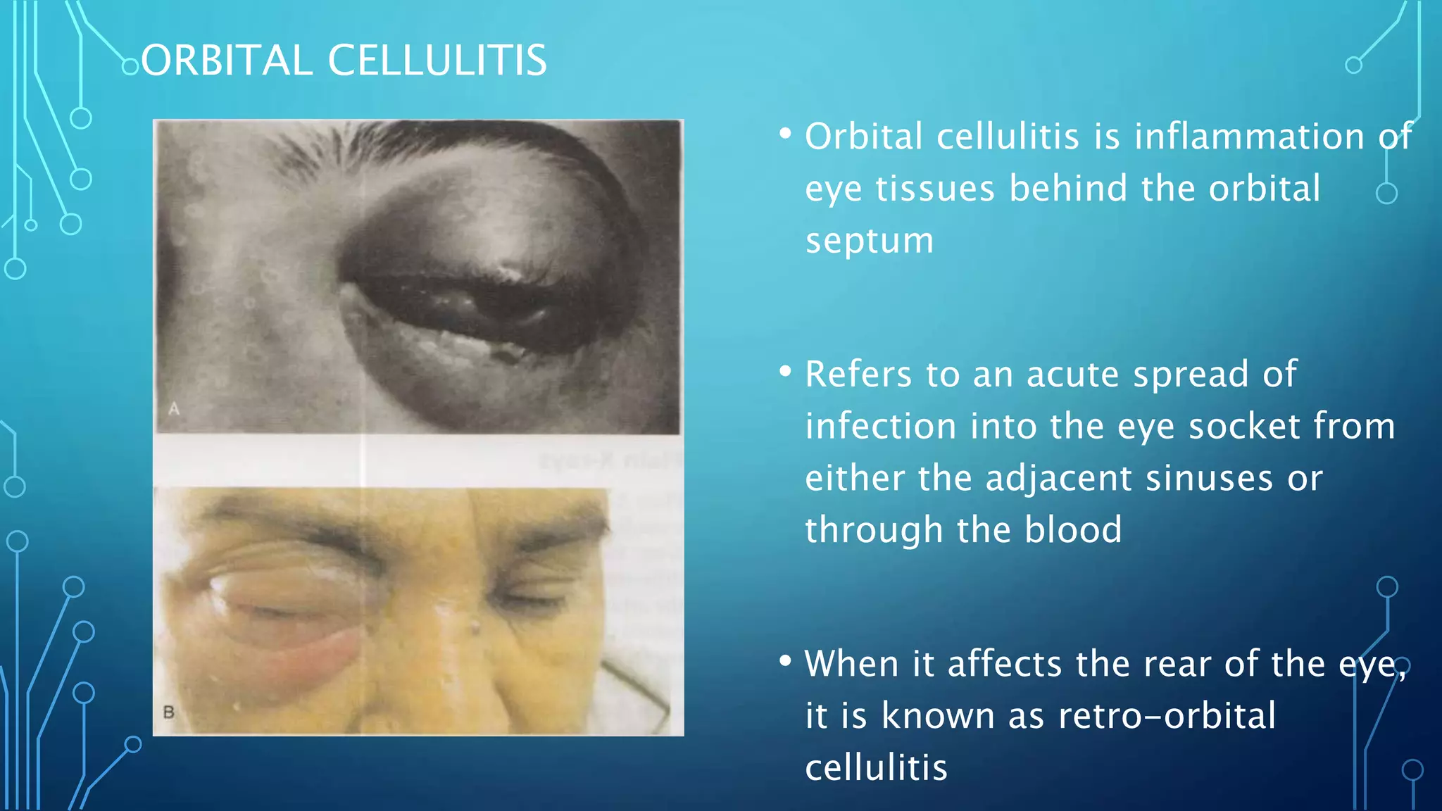 Orbital Cellulitis PPTX Orbital Cellulitis PPTX
