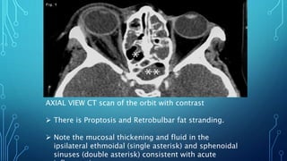 AXIAL VIEW CT scan of the orbit with contrast
 There is Proptosis and Retrobulbar fat stranding.
 Note the mucosal thickening and fluid in the
ipsilateral ethmoidal (single asterisk) and sphenoidal
sinuses (double asterisk) consistent with acute
 