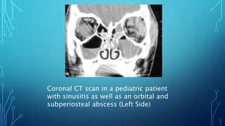 Coronal CT scan in a pediatric patient
with sinusitis as well as an orbital and
subperiosteal abscess (Left Side)
 