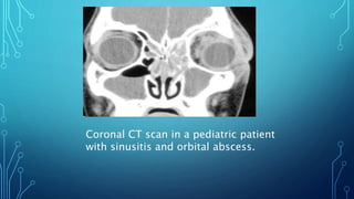 Coronal CT scan in a pediatric patient
with sinusitis and orbital abscess.
 