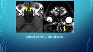 Orbital cellulitis and abscess
 