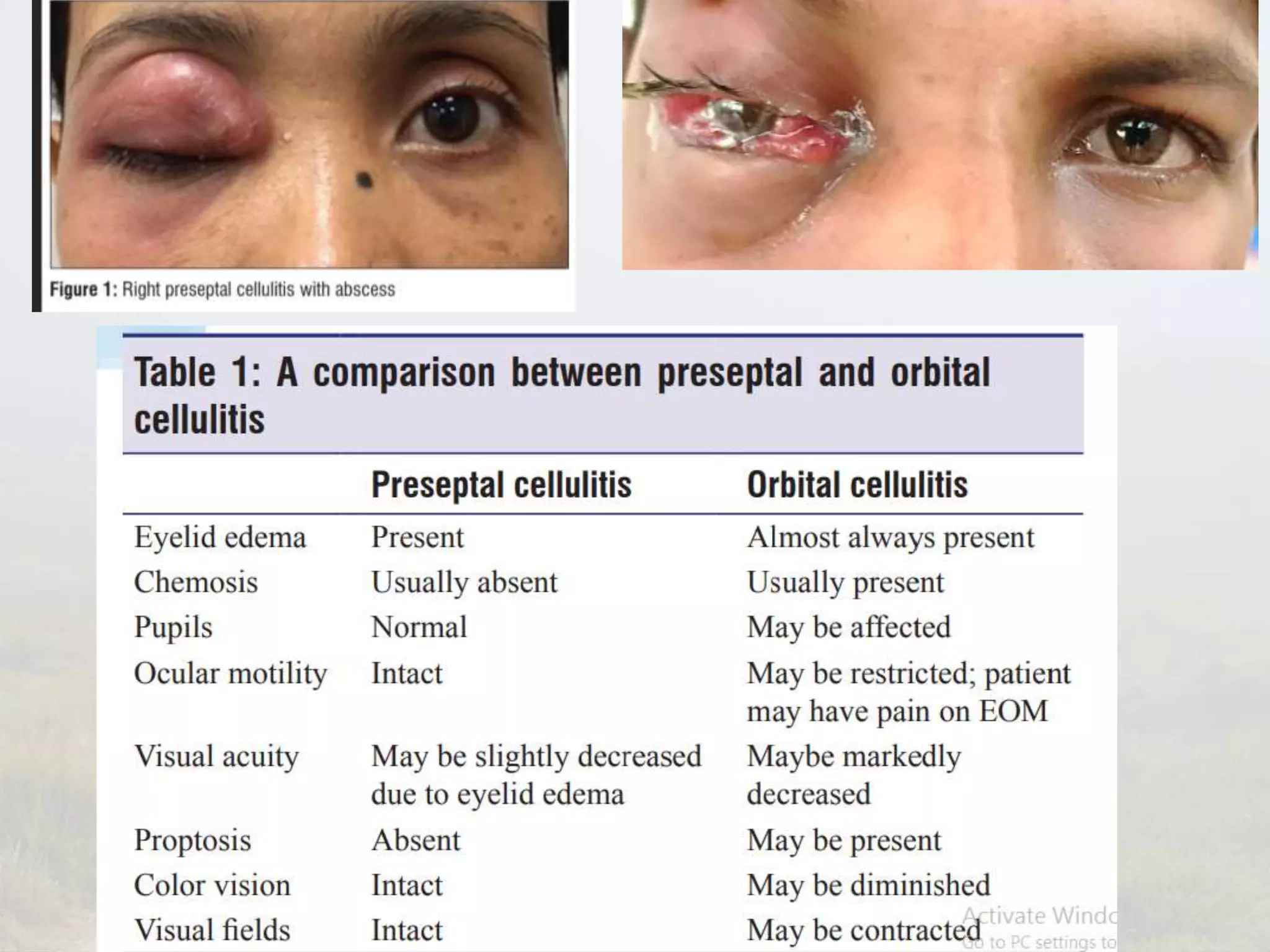 Orbital Cellulitis PPTX Orbital Cellulitis PPTX