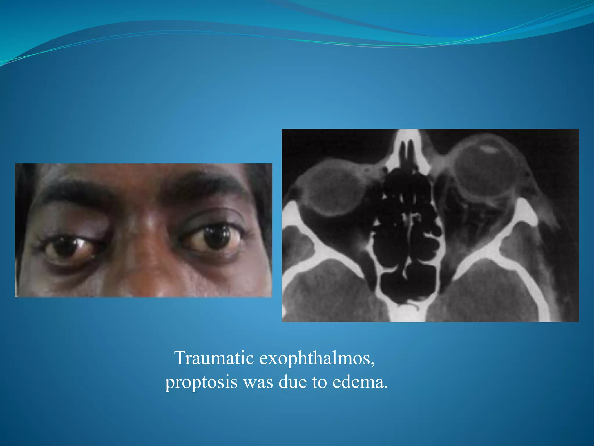 Orbital floor blow out fractures | PPTX
