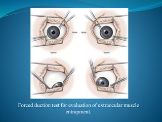 Orbital floor blow out fractures | PPTX