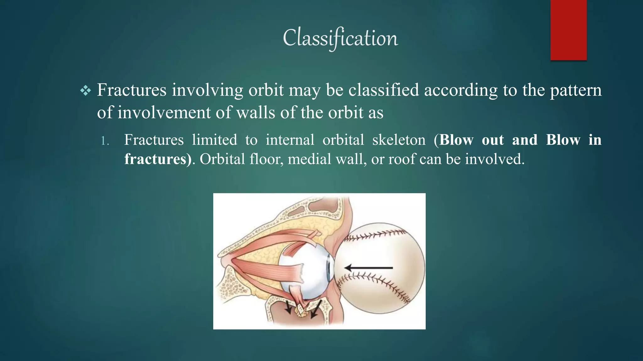 Orbital fracture | PPTX