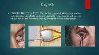 Orbital fracture | PPTX