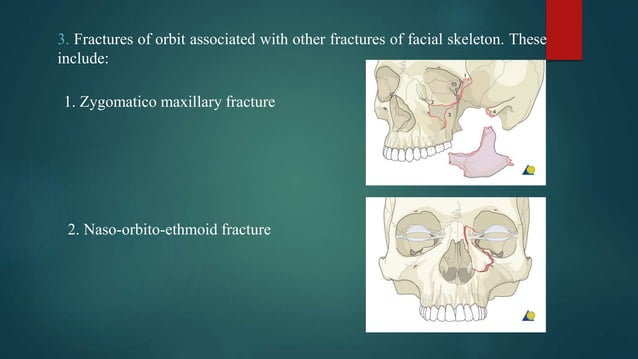 Orbital fracture | PPTX