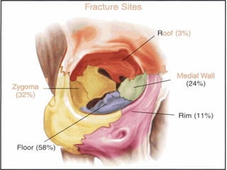 Orbital fracture | PPT