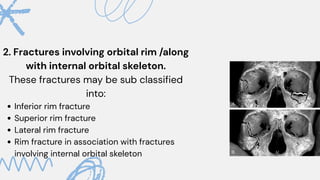 Lateral Rim Orbital fracture, anatomy , surgical aproch | PDF