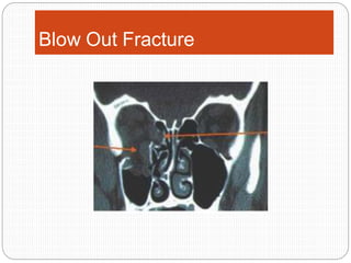 Blow Out Fracture
 