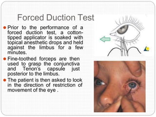 Forced Duction Test
⚫ Prior to the performance of a
forced duction test, a cotton-
tipped applicator is soaked with
topical anesthetic drops and held
against the limbus for a few
minutes.
⚫ Fine-toothed forceps are then
used to grasp the conjunctiva
and Tenon’s capsule just
posterior to the limbus.
⚫ The patient is then asked to look
in the direction of restriction of
movement of the eye .
 