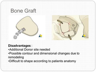 Bone Graft
Disadvantages :
•Additional Donor site needed
•Possible contour and dimensional changes due to
remodeling
•Difficult to shape according to patients anatomy
 