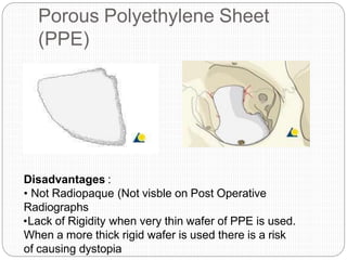 Porous Polyethylene Sheet
(PPE)
Disadvantages :
• Not Radiopaque (Not visble on Post Operative
Radiographs
•Lack of Rigidity when very thin wafer of PPE is used.
When a more thick rigid wafer is used there is a risk
of causing dystopia
 