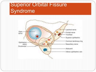 Superior Orbital Fissure
Syndrome
 