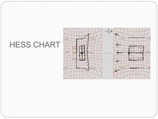 HESS CHART
 