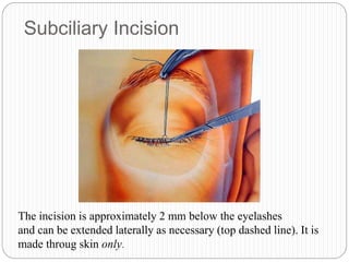 Subciliary Incision
The incision is approximately 2 mm below the eyelashes
and can be extended laterally as necessary (top dashed line). It is
made throug skin only.
 