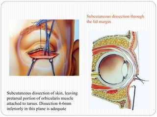 Subcutaneous dissection of skin, leaving
pretarsal portion of orbicularis muscle
attached to tarsus. Dissection 4-6mm
inferiorly in this plane is adequate
Subcutaneous dissection through
the lid margin
 