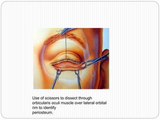 Use of scissors to dissect through
orbicularis oculi muscle over lateral orbital
rim to identify
periosteum.
 