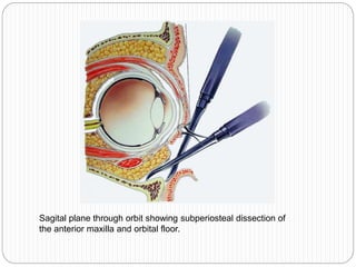 Sagital plane through orbit showing subperiosteal dissection of
the anterior maxilla and orbital floor.
 