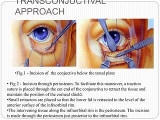 TRANSCONJUCTIVAL
APPROACH
•Fig.1 - Incision of the conjuctiva below the tarsal plate
• Fig 2 - Incision through periosteum. To facilitate this maneuver, a traction
suture is placed through the cut end of the conjunctiva to retract the tissue and
maintain the position of the corneal shield.
•Small retractors are placed so that the lower lid is retracted to the level of the
anterior surface of the infraorbital rim.
•The intervening tissue along the infraorbital rim is the periosteum. The incision
is made through the periosteum just posterior to the infraorbital rim.
 