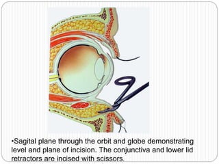 •Sagital plane through the orbit and globe demonstrating
level and plane of incision. The conjunctiva and lower lid
retractors are incised with scissors.
 