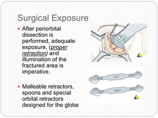 Surgical Exposure
 After periorbital
dissection is
performed, adequate
exposure, (proper
retraction) and
illumination of the
fractured area is
imperative.
 Malleable retractors,
spoons and special
orbital retractors
designed for the globe
 
