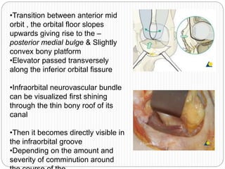 •Transition between anterior mid
orbit , the orbital floor slopes
upwards giving rise to the –
posterior medial bulge & Slightly
convex bony platform
•Elevator passed transversely
along the inferior orbital fissure
•Infraorbital neurovascular bundle
can be visualized first shining
through the thin bony roof of its
canal
•Then it becomes directly visible in
the infraorbital groove
•Depending on the amount and
severity of comminution around
 
