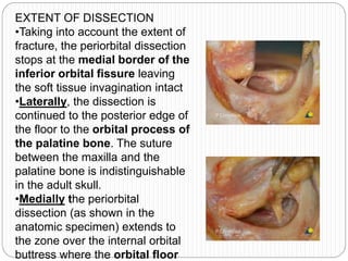 EXTENT OF DISSECTION
•Taking into account the extent of
fracture, the periorbital dissection
stops at the medial border of the
inferior orbital fissure leaving
the soft tissue invagination intact
•Laterally, the dissection is
continued to the posterior edge of
the floor to the orbital process of
the palatine bone. The suture
between the maxilla and the
palatine bone is indistinguishable
in the adult skull.
•Medially the periorbital
dissection (as shown in the
anatomic specimen) extends to
the zone over the internal orbital
buttress where the orbital floor
 