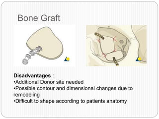 Bone Graft
Disadvantages :
•Additional Donor site needed
•Possible contour and dimensional changes due to
remodeling
•Difficult to shape according to patients anatomy
 