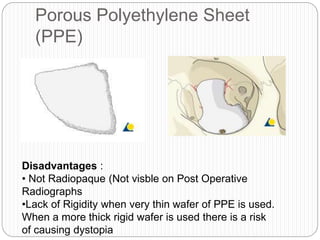 Porous Polyethylene Sheet
(PPE)
Disadvantages :
• Not Radiopaque (Not visble on Post Operative
Radiographs
•Lack of Rigidity when very thin wafer of PPE is used.
When a more thick rigid wafer is used there is a risk
of causing dystopia
 