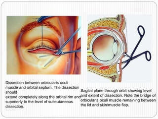Dissection between orbicularis oculi
muscle and orbital septum. The dissection
should
extend completely along the orbital rim and
superiorly to the level of subcutaneous
dissection.
Sagital plane through orbit showing level
and extent of dissection. Note the bridge of
orbicularis oculi muscle remaining between
the lid and skin/muscle flap.
 